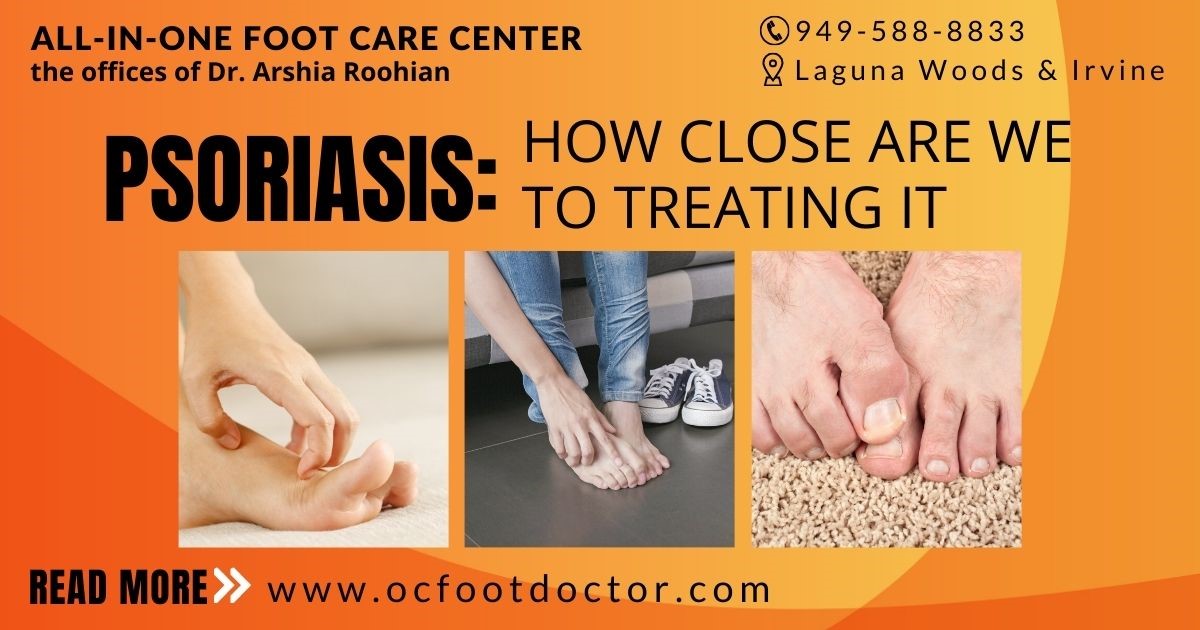 Psoriasis How Close Are We To Treating It?